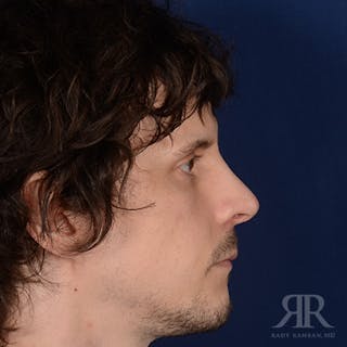 Male Rhinoplasty Before & After Gallery - Patient 230553 - Image 4
