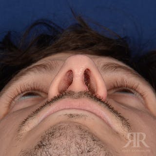 Male Rhinoplasty Before & After Gallery - Patient 230553 - Image 6
