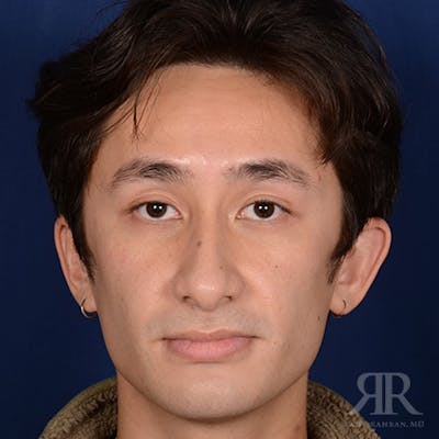 Male Rhinoplasty Before & After Gallery - Patient 397163 - Image 1