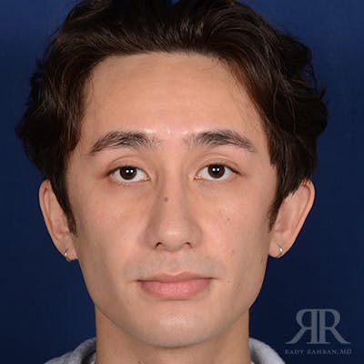 Male Rhinoplasty Before & After Gallery - Patient 397163 - Image 2