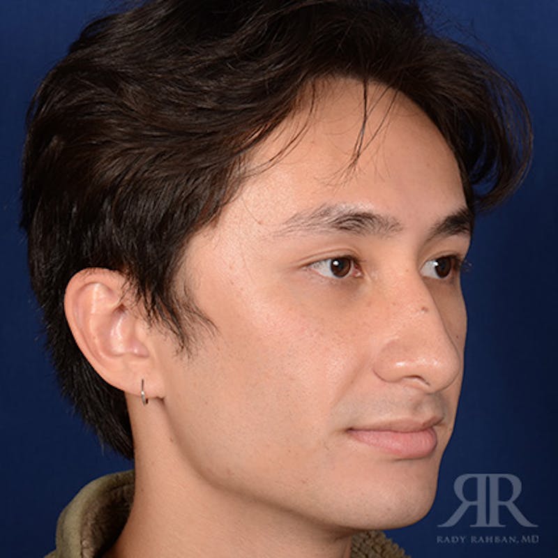 Male Rhinoplasty Before & After Gallery - Patient 397163 - Image 3