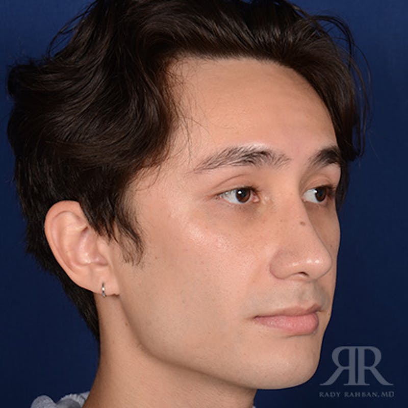 Male Rhinoplasty Before & After Gallery - Patient 397163 - Image 4