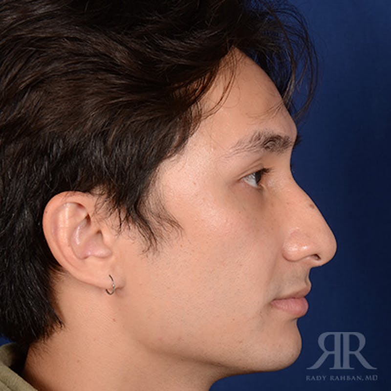 Male Rhinoplasty Before & After Gallery - Patient 397163 - Image 5
