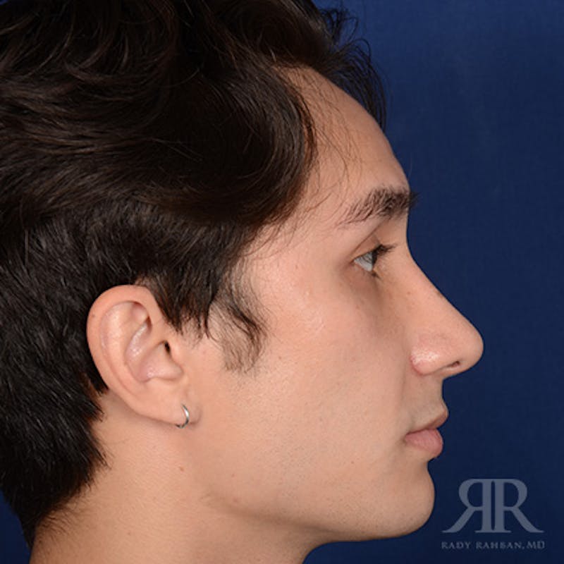 Male Rhinoplasty Before & After Gallery - Patient 397163 - Image 6