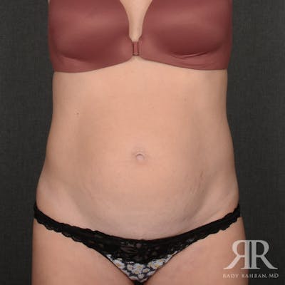 Tummy Tuck Before & After Gallery - Patient 394562 - Image 1