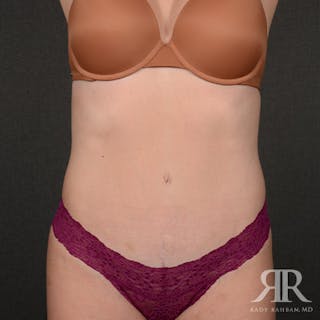 Tummy Tuck Before & After Gallery - Patient 394562 - Image 2