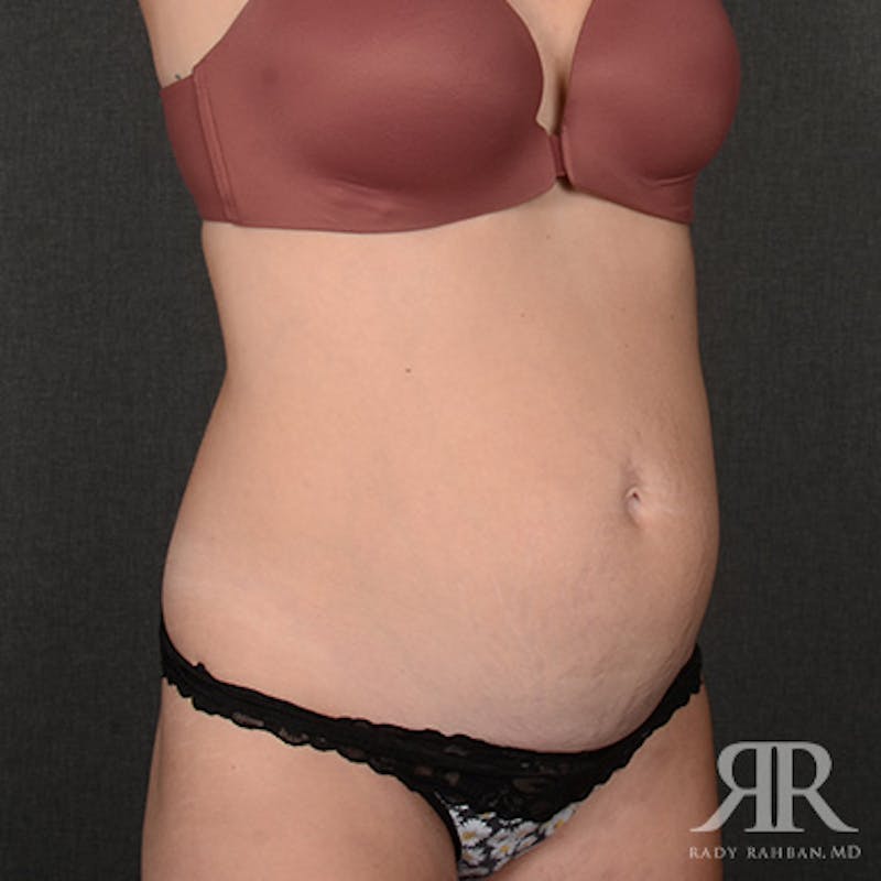 Tummy Tuck Before & After Gallery - Patient 394562 - Image 3