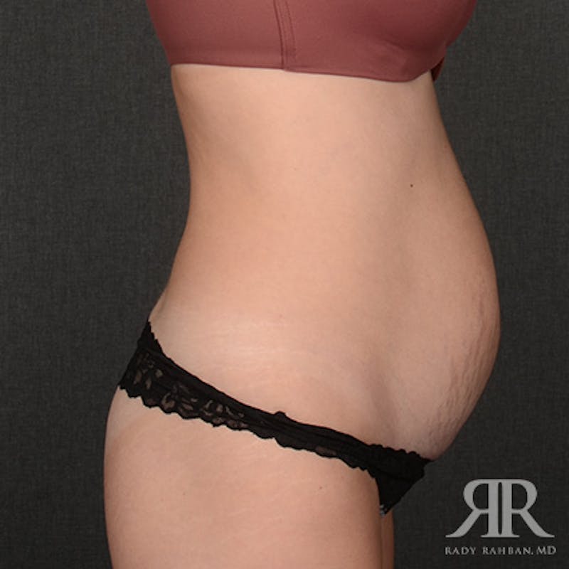 Tummy Tuck Before & After Gallery - Patient 394562 - Image 5