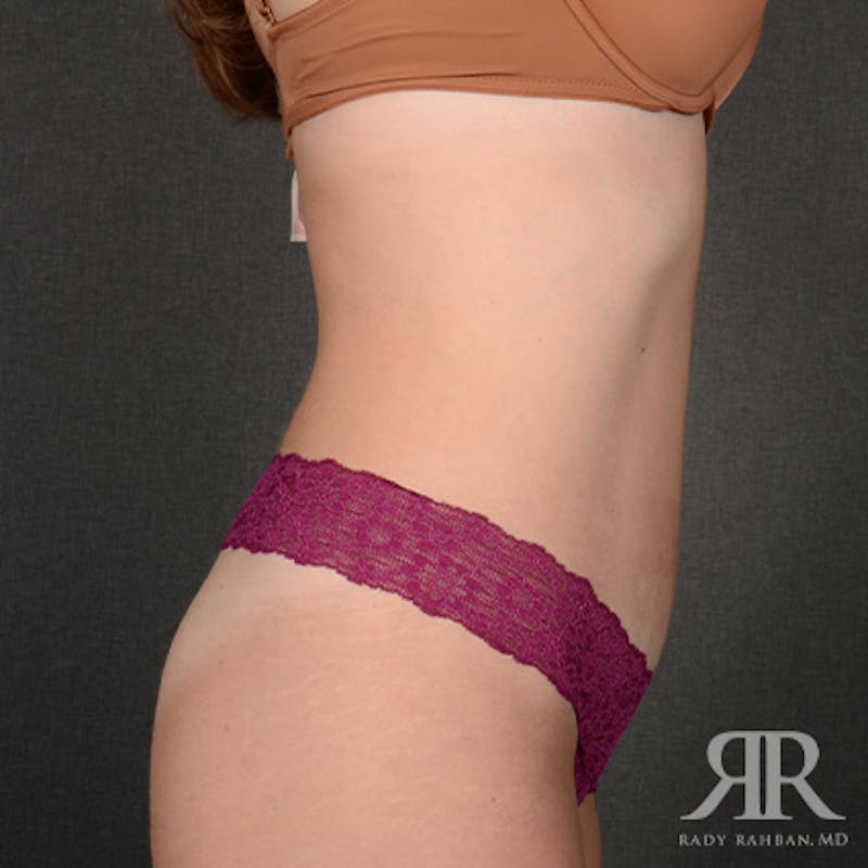 Tummy Tuck Before & After Gallery - Patient 394562 - Image 6