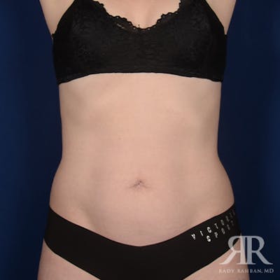 Tummy Tuck Before & After Gallery - Patient 267481 - Image 1