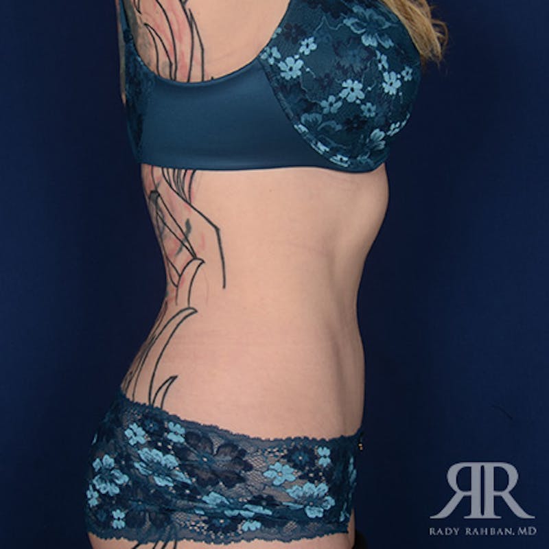 Tummy Tuck Before & After Gallery - Patient 267481 - Image 6