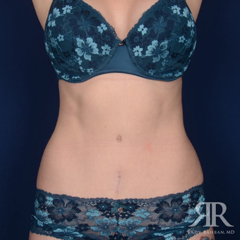 Tummy Tuck Before & After Gallery - Patient 267481 - Image 2