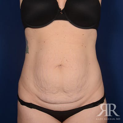 Tummy Tuck Before & After Gallery - Patient 975600 - Image 1