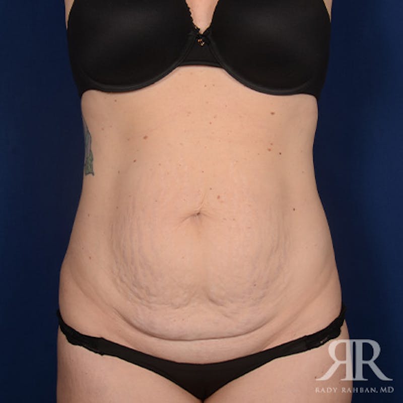 Tummy Tuck Before & After Gallery - Patient 975600 - Image 1