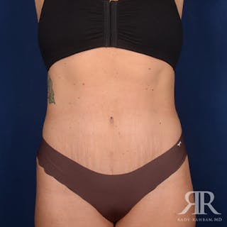 Tummy Tuck Before & After Gallery - Patient 975600 - Image 2