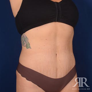 Tummy Tuck Before & After Gallery - Patient 975600 - Image 4