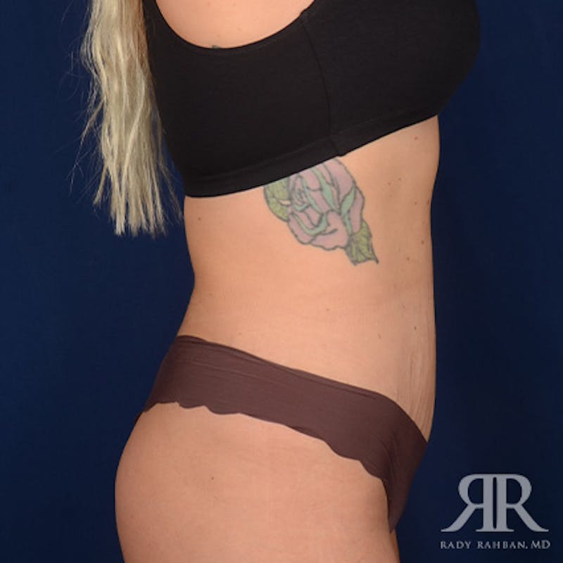 Tummy Tuck Before & After Gallery - Patient 975600 - Image 6