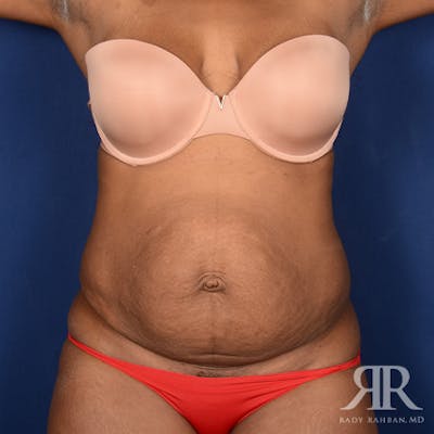 Tummy Tuck Before & After Gallery - Patient 254168 - Image 1