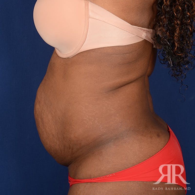 Tummy Tuck Before & After Gallery - Patient 254168 - Image 5