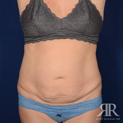Tummy Tuck Before & After Gallery - Patient 354773 - Image 1