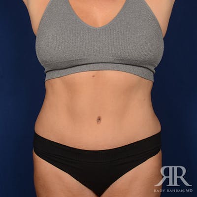 Tummy Tuck Before & After Gallery - Patient 354773 - Image 2