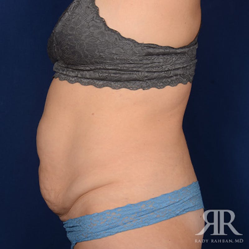 Tummy Tuck Before & After Gallery - Patient 354773 - Image 5