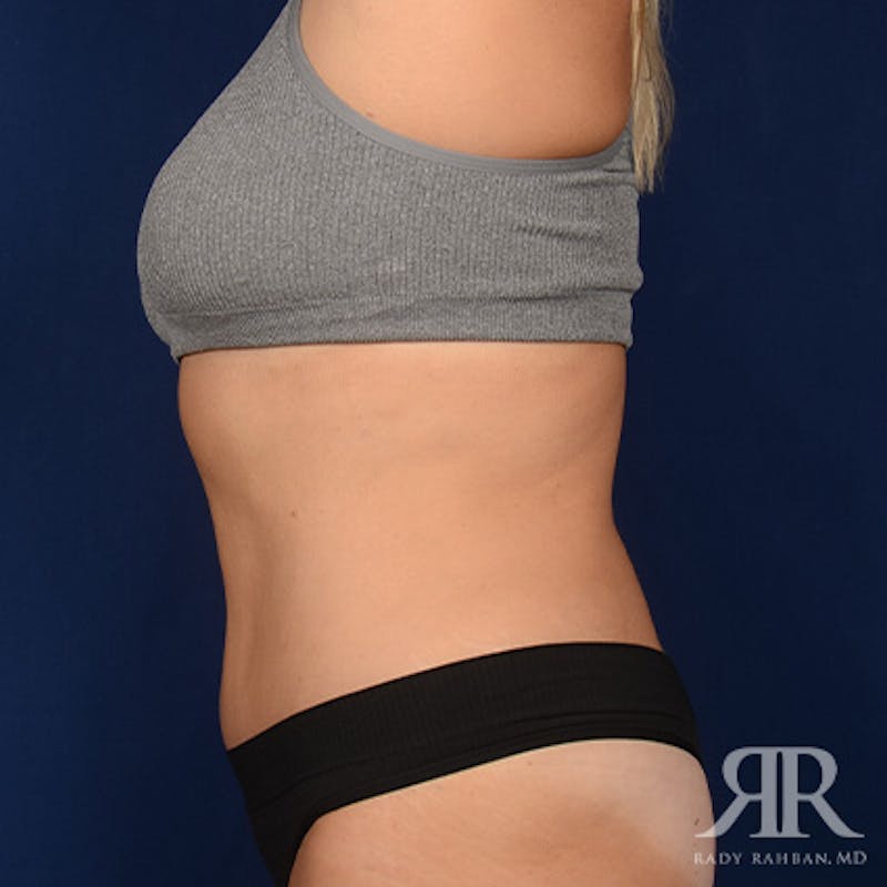 Tummy Tuck Before & After Gallery - Patient 354773 - Image 6