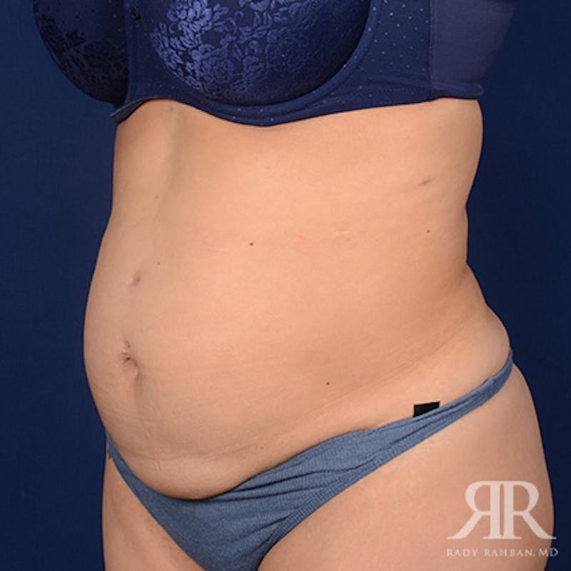 Tummy Tuck Before & After Gallery - Patient 837131 - Image 3
