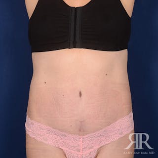 Tummy Tuck Before & After Gallery - Patient 218576 - Image 2