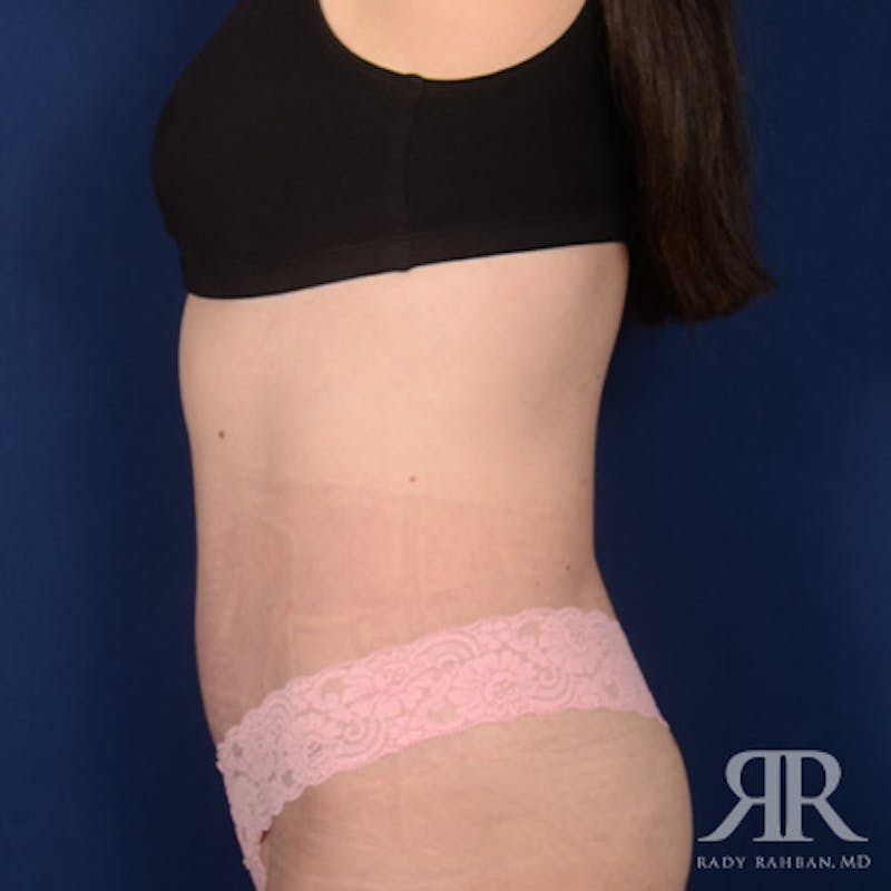 Tummy Tuck Before & After Gallery - Patient 218576 - Image 6