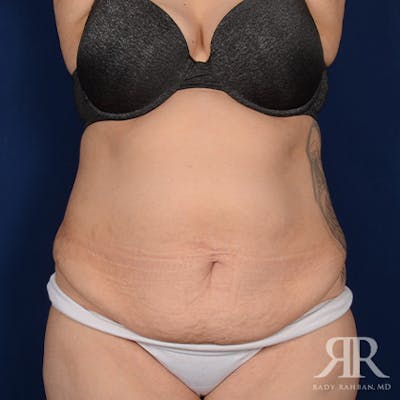 Tummy Tuck Before & After Gallery - Patient 266821 - Image 1