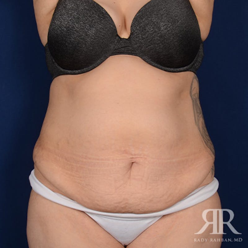 Tummy Tuck Before & After Gallery - Patient 266821 - Image 1