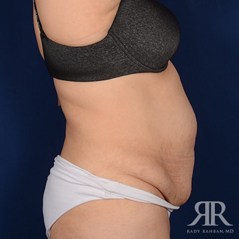 Tummy Tuck Before & After Gallery - Patient 266821 - Image 5