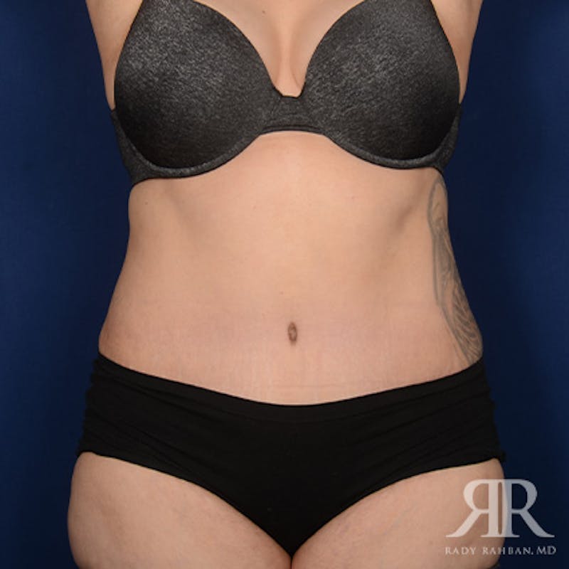 Tummy Tuck Before & After Gallery - Patient 266821 - Image 2