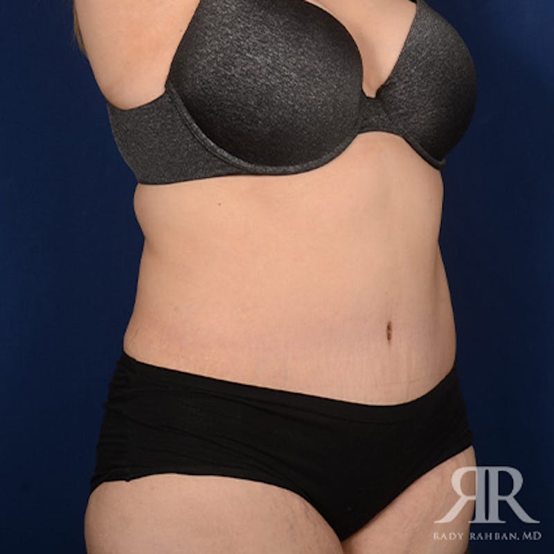 Tummy Tuck Before & After Gallery - Patient 266821 - Image 4