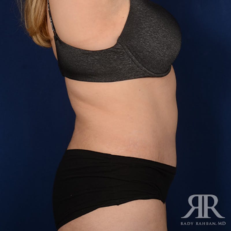 Tummy Tuck Before & After Gallery - Patient 266821 - Image 6