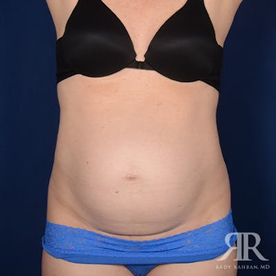 Tummy Tuck Before & After Gallery - Patient 246797 - Image 1