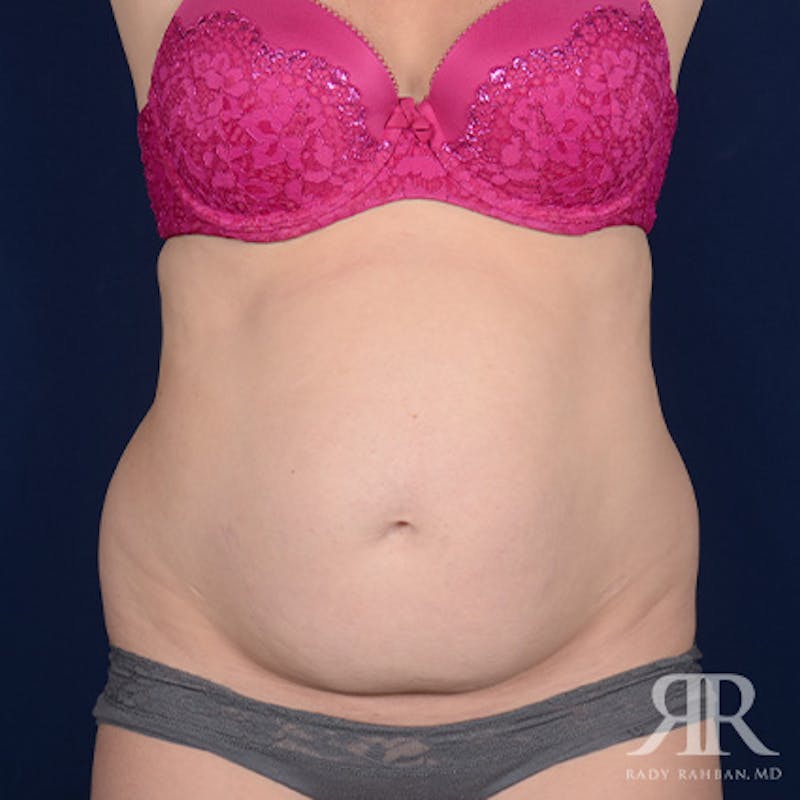 Tummy Tuck Before & After Gallery - Patient 129868 - Image 1