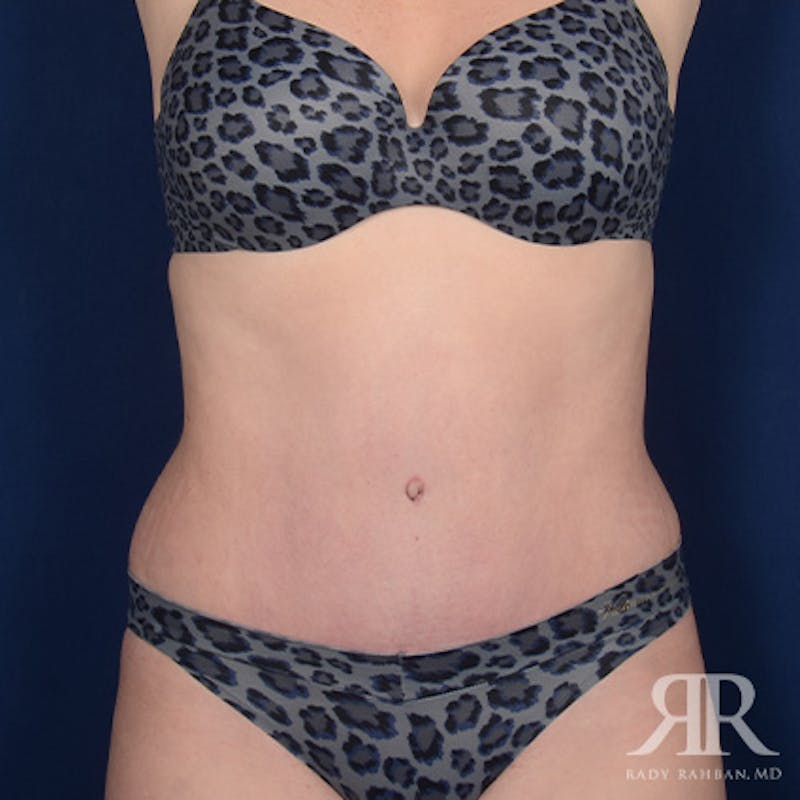 Tummy Tuck Before & After Gallery - Patient 129868 - Image 2