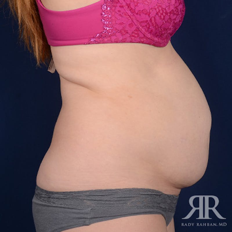Tummy Tuck Before & After Gallery - Patient 129868 - Image 5