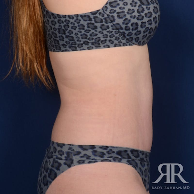 Tummy Tuck Before & After Gallery - Patient 129868 - Image 6