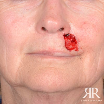 Mohs Surgery Before & After Gallery - Patient 356297 - Image 1