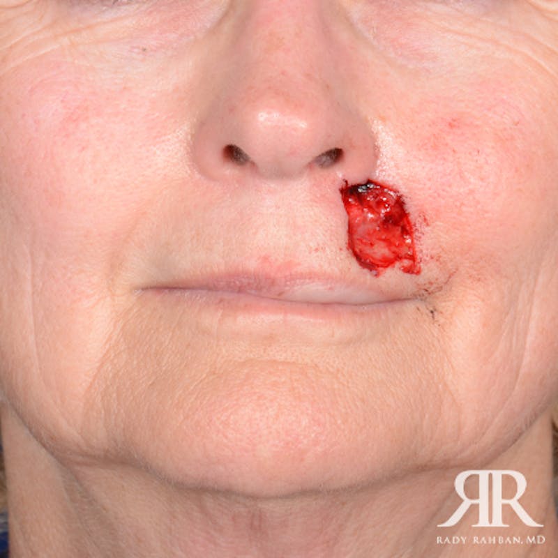 Mohs Surgery Before & After Gallery - Patient 356297 - Image 1