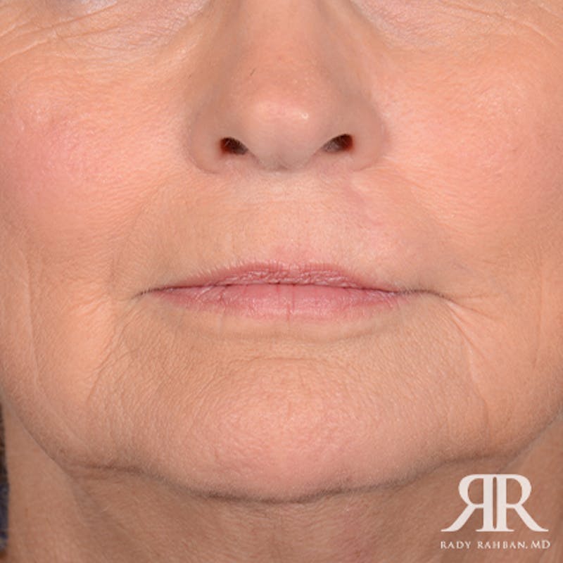 Mohs Surgery Before & After Gallery - Patient 356297 - Image 2