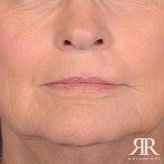 Mohs Surgery Before & After Gallery - Patient 356297 - Image 2