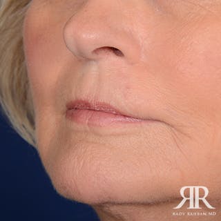 Mohs Surgery Before & After Gallery - Patient 356297 - Image 4