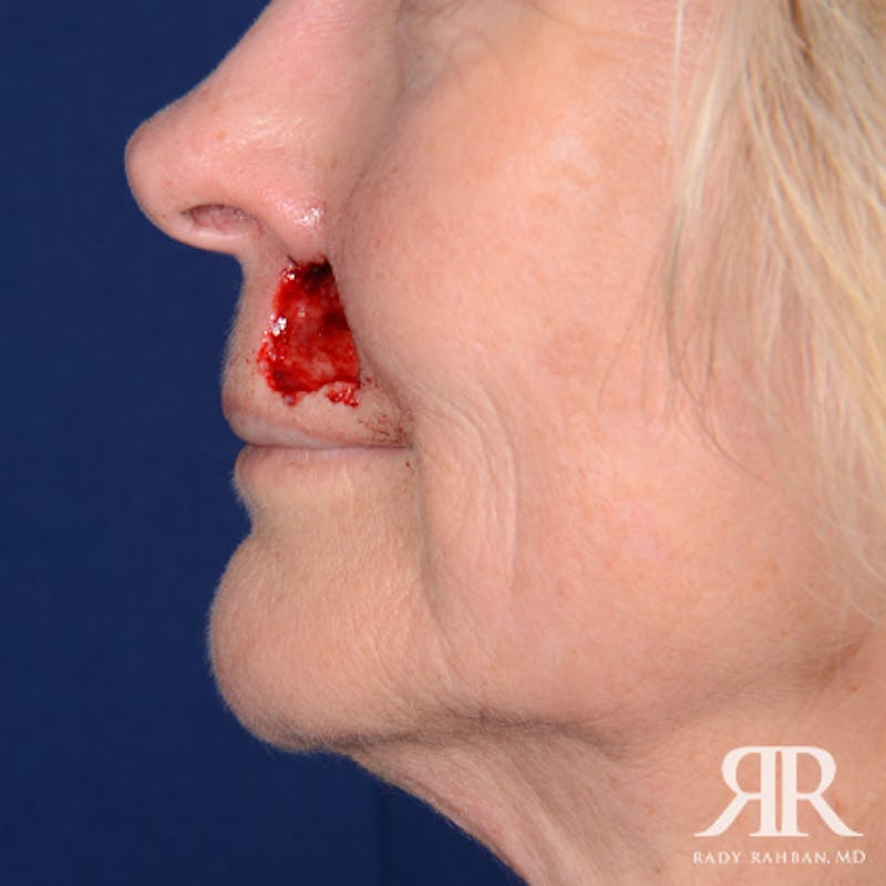 Mohs Surgery Before & After Gallery - Patient 356297 - Image 5
