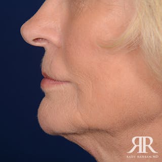 Mohs Surgery Before & After Gallery - Patient 356297 - Image 6