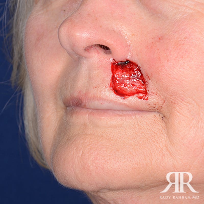 Mohs Surgery Before & After Gallery - Patient 356297 - Image 3