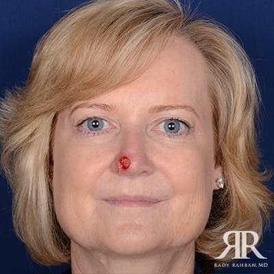 Mohs Surgery Before & After Gallery - Patient 396001 - Image 1